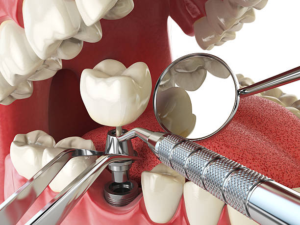 Best Chipped Tooth Repair Near Me  in Summerside, OH